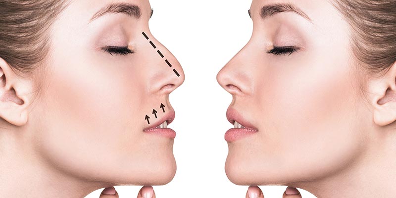 Rhinoplasty Refine Cosmetic Clinic