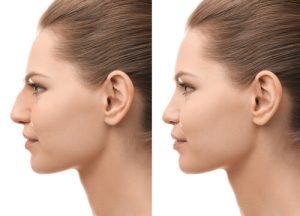postsurgical effects rhinoplasty