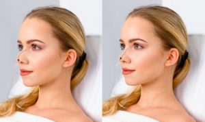 rhinoplasty results