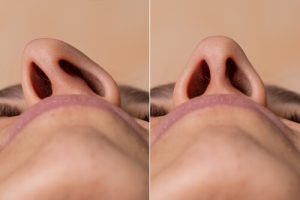 what is deviated septum signs