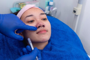 nonsurgical rhinoplasty procedure